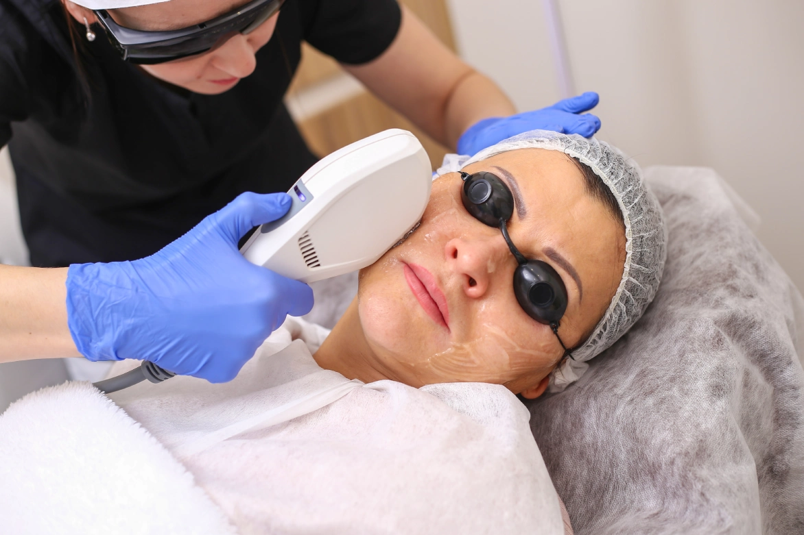 IPL Treatment