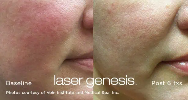 laser genesis 2_1