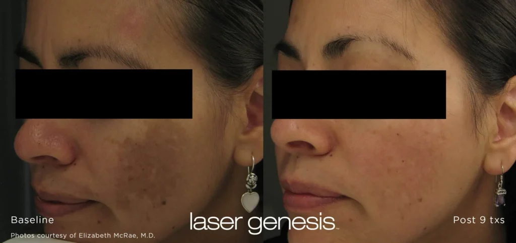 laser genesis 3_1