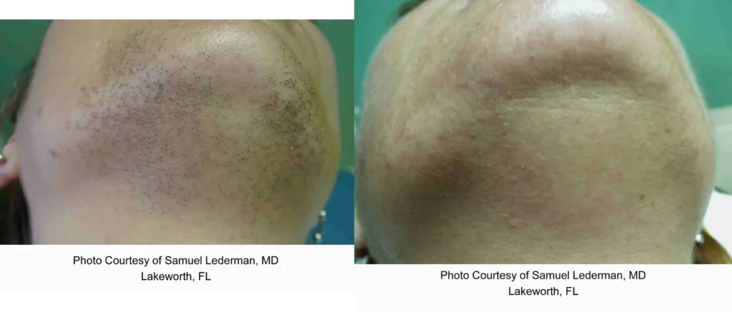 laser hair removal (1)_1