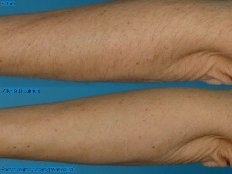 laser hair removal 2_1