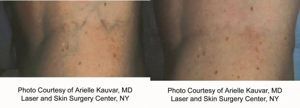reticular veins_1