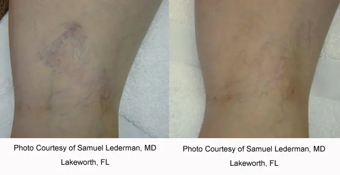 spider veins 2_1