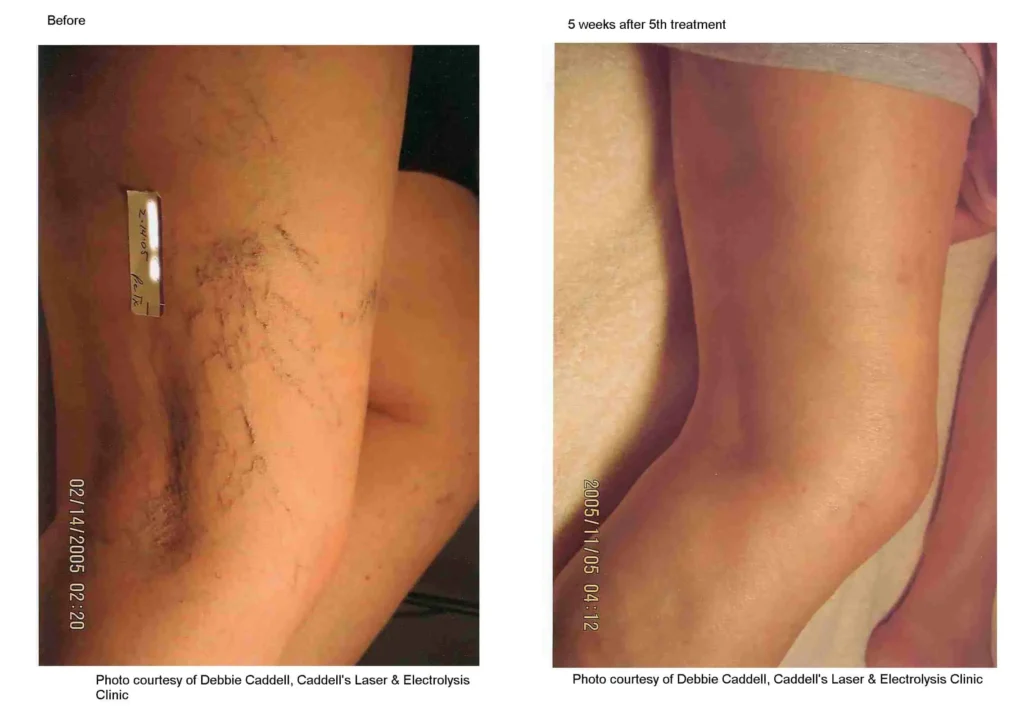 spider veins_1