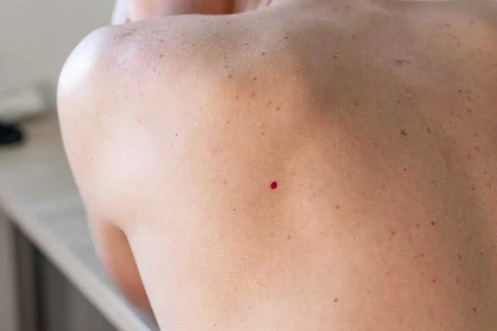 Cherry Angiomas by Awaken aesthetics in Hammonton, NJ