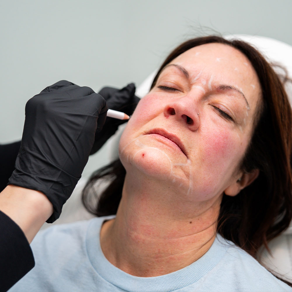 A woman receiving facial cosmetic treatment as practitioner in black gloves marks injection points along jaw and cheek