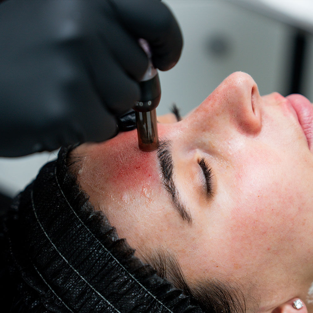Woman undergoing microneedling treatment on forehead near eyebrow by gloved technician
