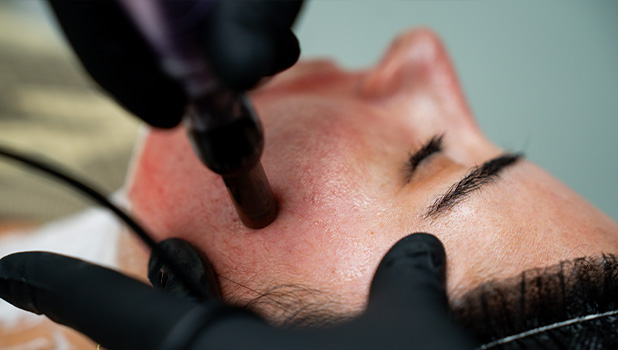 Close-up of a person receiving microneedling facial treatment on the cheek, practitioner wearing black gloves