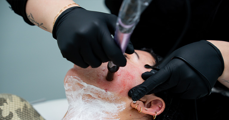Woman receiving microneedling facial treatment while technician in black gloves treats cheek with device and numbing cream.